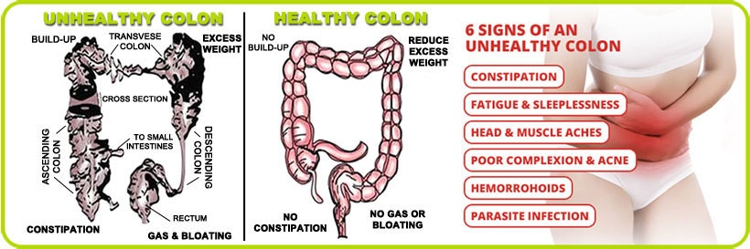 Healthy Colon vs Unhealthy Colon Healthy Colon vs Unhealthy Colon