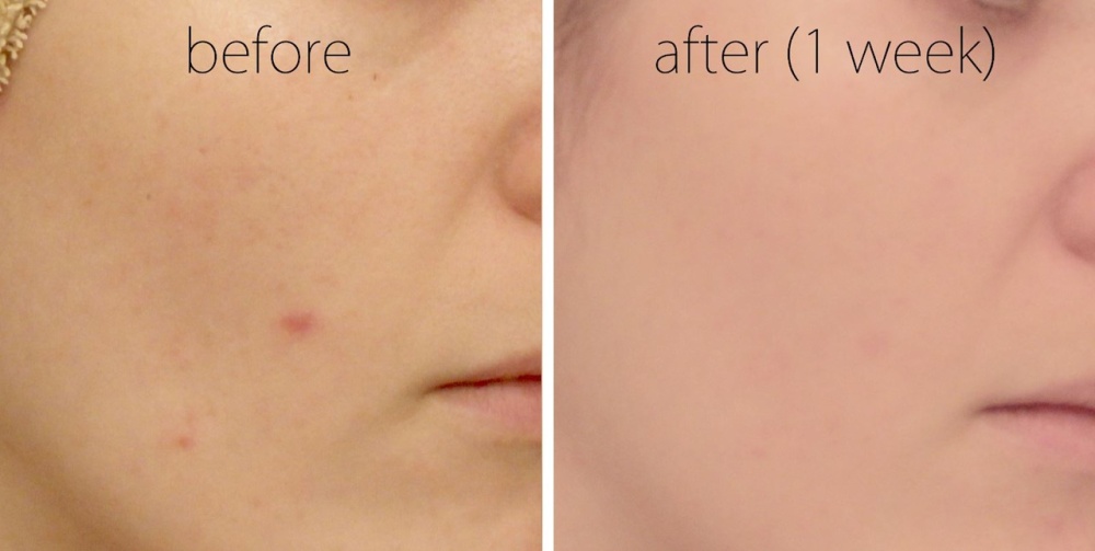 Ivermectin after food